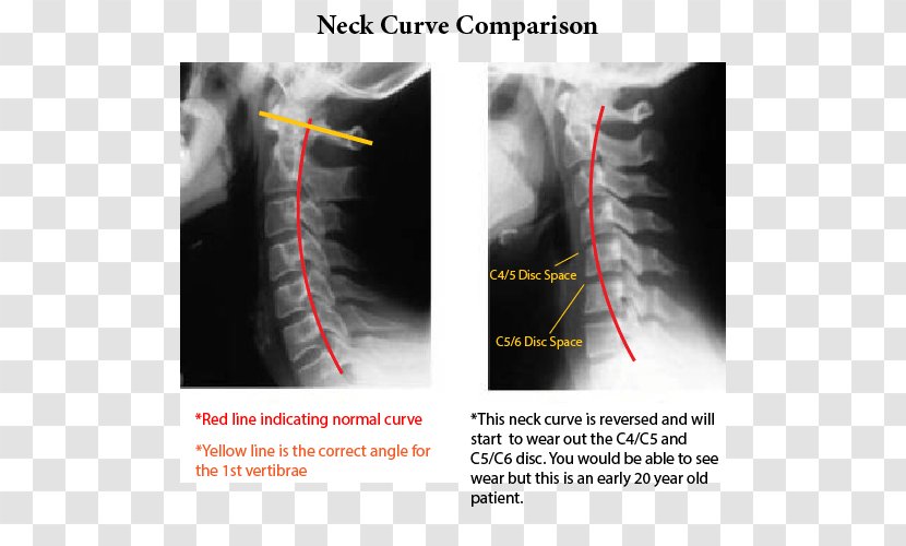 Neck Pain Whiplash Cervical Vertebrae X-ray - X Ray - Normal Curve Transparent PNG