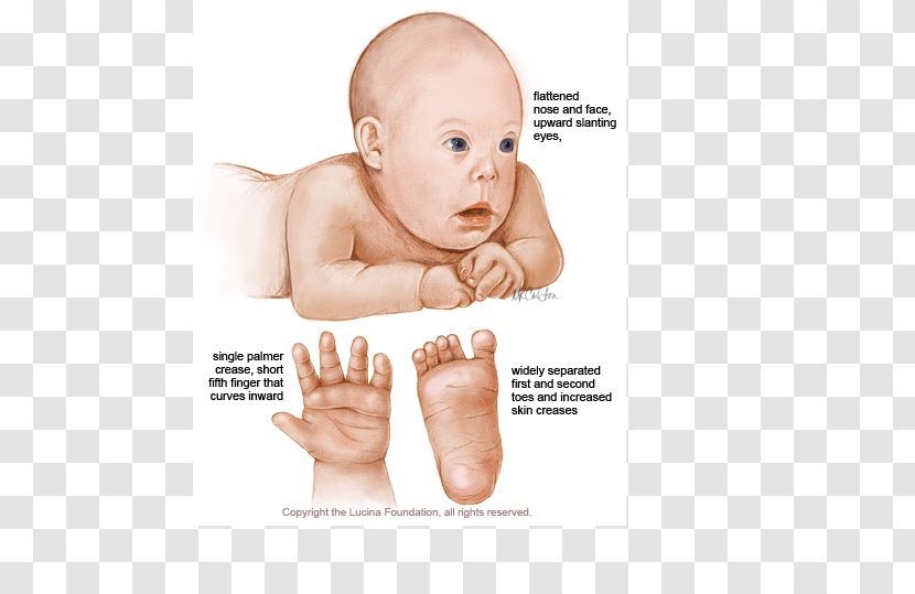 Trisomy Down Syndrome Chromosome 21 Abnormality - Tree - Silhouette Transparent PNG