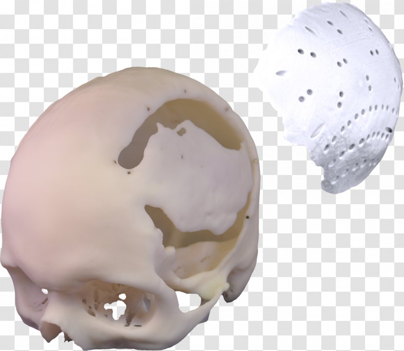 3D Printing Poly Xilloc Implant Plastic - Bone Material Transparent PNG