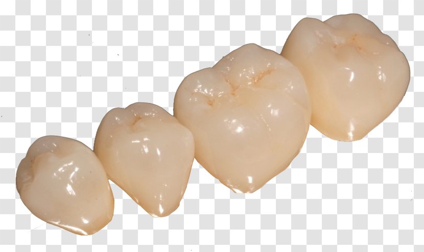 Dentures Prótesis Fija Tooth Crown Dentist - Steel Teeth Transparent PNG