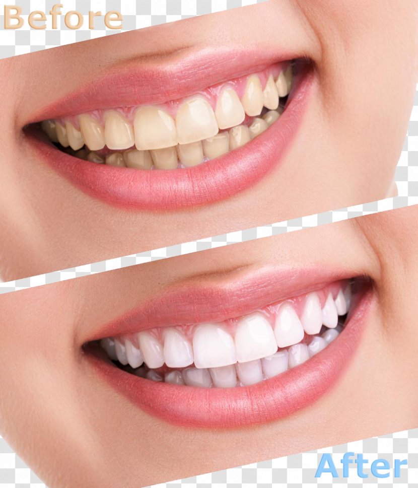 Tooth Whitening Human Cosmetic Dentistry - Dentures - Comparison Of Cleaning Teeth Transparent PNG