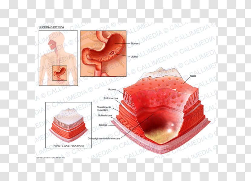 Skin Ulcer Peptic Disease Gastric Erosion Gastritis - Silhouette Transparent PNG