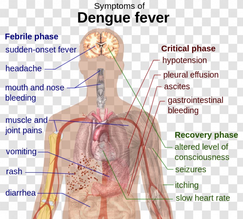 Mosquito Dengue Fever Scarlet Disease Complication - Flower Transparent PNG