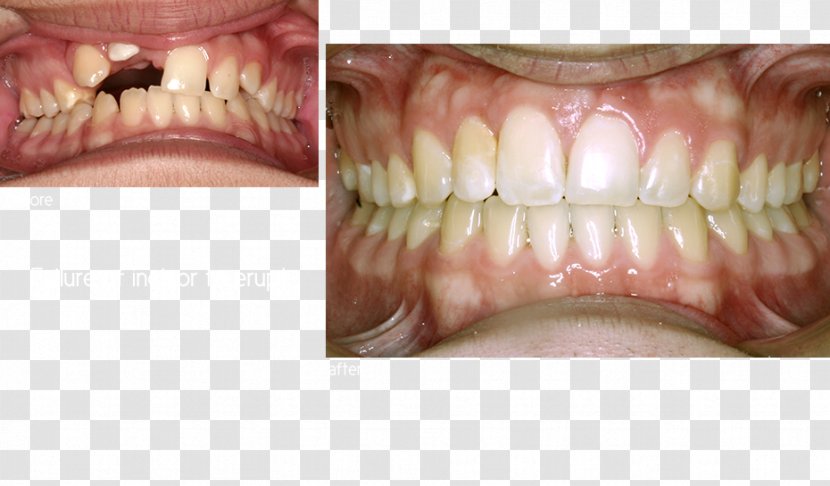 Human Tooth Dentures Close-up - Lip - Dastrup Kent A Dds Transparent PNG