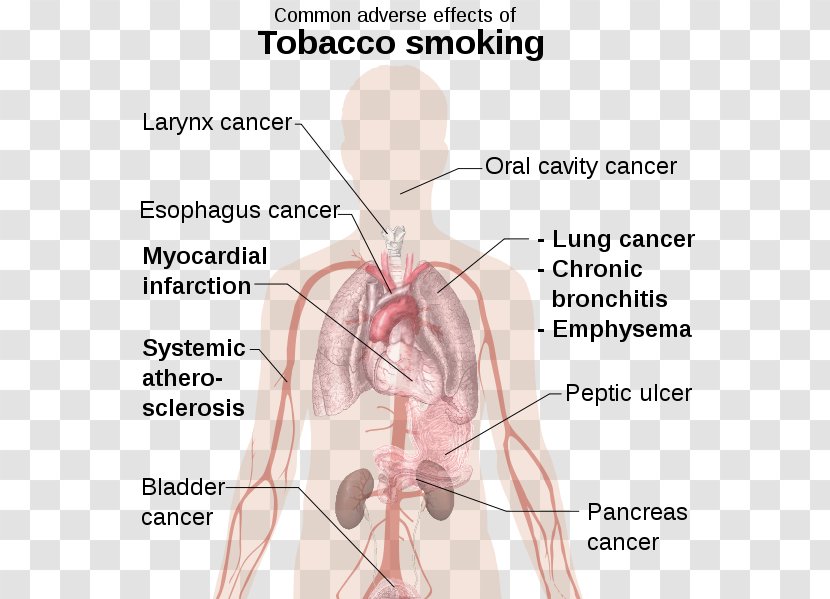 Tobacco Smoking Cessation Adverse Effect - Tree - Health Transparent PNG