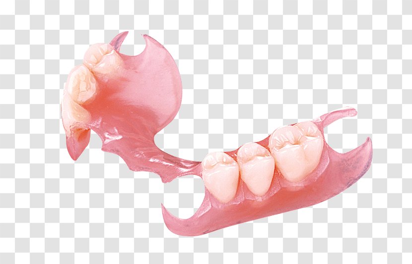 Removable Partial Denture Dentures Dentistry Crown - Temporary Transparent PNG