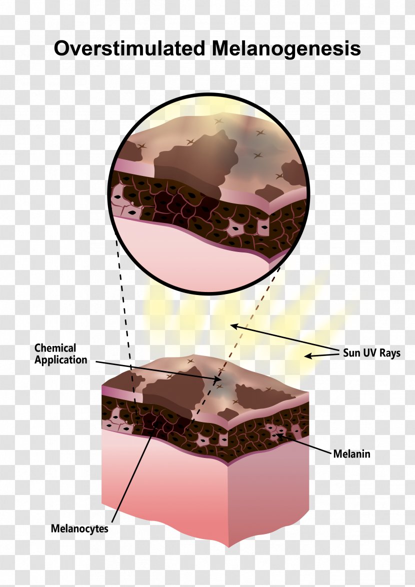 Melanin Hyperpigmentation Hypopigmentation Melanocyte Skin - Ingredient Transparent PNG