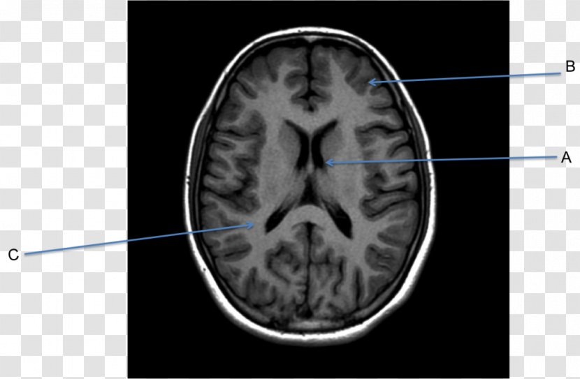 Magnetic Resonance Imaging Of The Brain Computed Tomography Neuroimaging - Frame - African American Business Transparent PNG