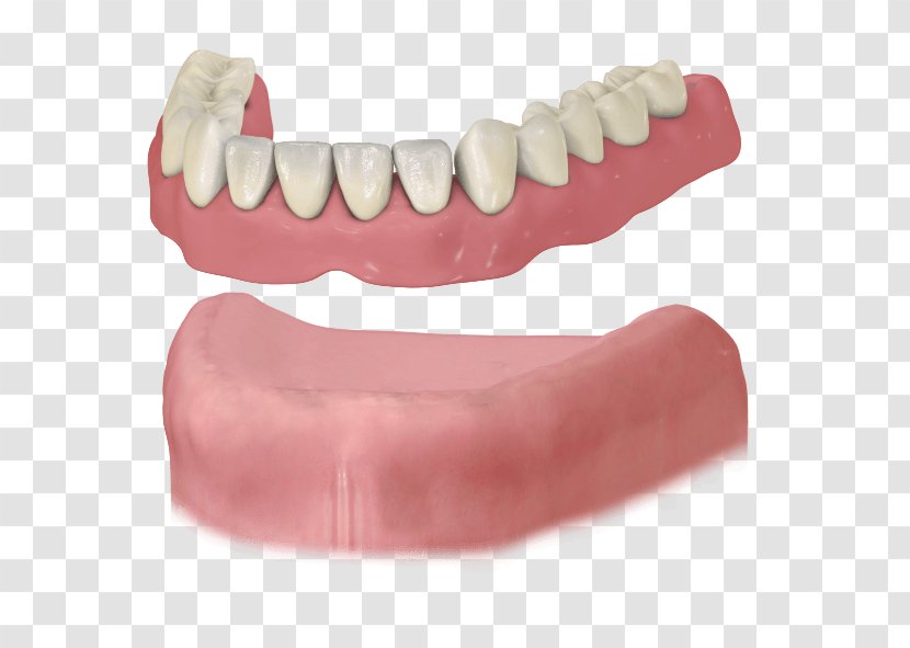 Dental Implant Dentures Removable Partial Denture Dentistry - Watercolor - Bridge Transparent PNG