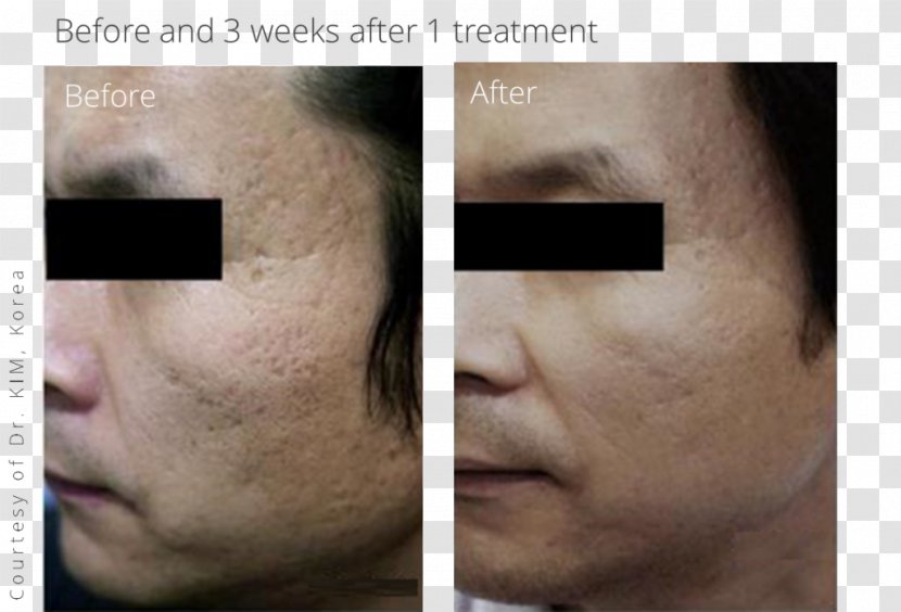 Scar Acne Cheek Surgery Wrinkle - Adverse Effect Transparent PNG