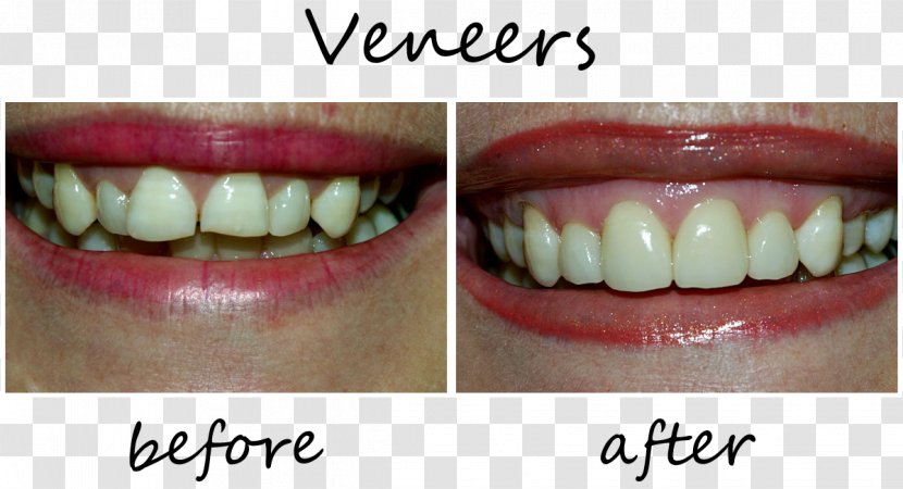 Tooth Veneer Dentistry Patient - Oral Hygiene - Smile Transparent PNG