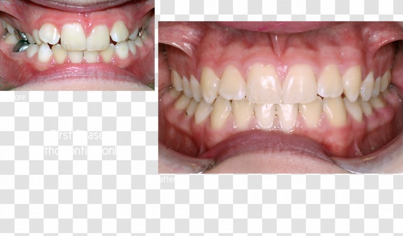 Tooth Dentures Close-up - Smile Transparent PNG