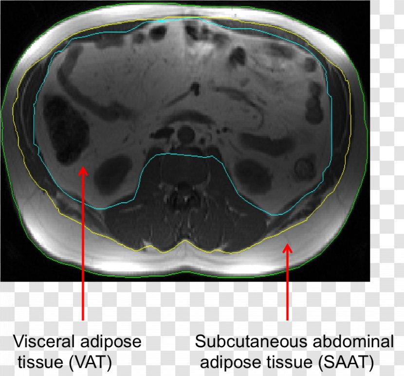 Non-alcoholic Fatty Liver Disease Gastroenterology - Personal Protective Equipment - Cancer Transparent PNG