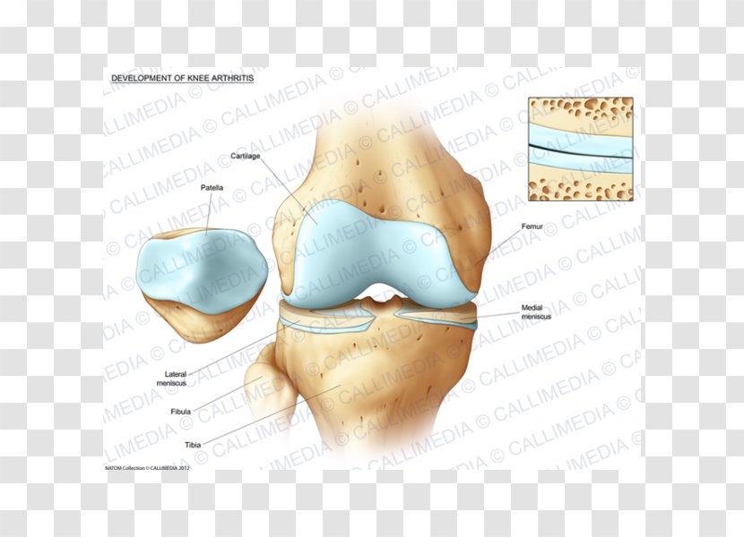Knee Bone Fracture Tibia Pathology - Heart - Ráº¯n 3d Transparent PNG