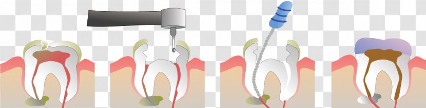 Endodontic Therapy Root Canal Endodontics Pulp Dentist - Cutlery - Health Transparent PNG