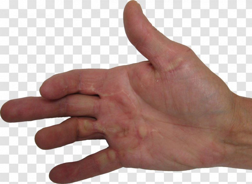 Dupuytren's Contracture Thumb Plantar Fibromatosis Disease Health - Therapy Transparent PNG