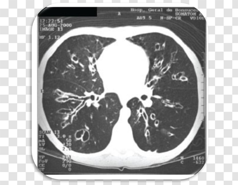 Computed Tomography Radiology Cystic Fibrosis Bronchiectasis - Flower - Aspergillus Transparent PNG