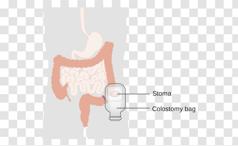 Colostomy Stoma Ileostomy Surgery Ostomy Pouching System - Flower - Hinh Nen Co Trang Transparent PNG