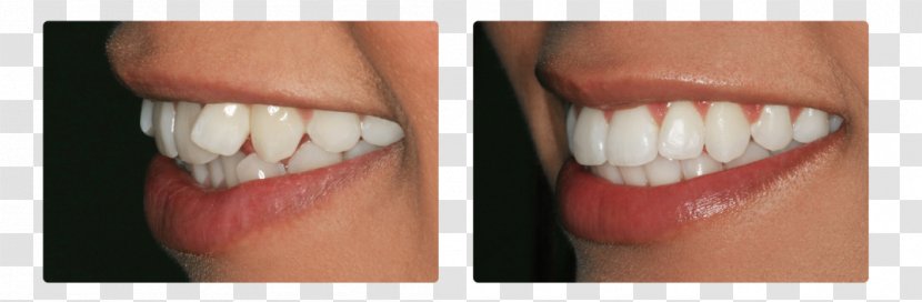 Tooth Cosmetic Dentistry ORDINACIJA DENTALNE MEDICINE JASNA CUPEC - Human - Dental Braces Transparent PNG