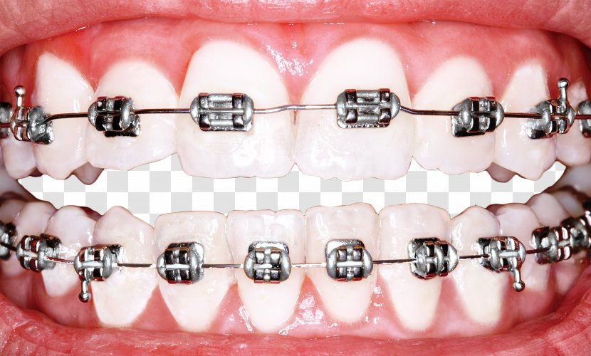 Dental Braces Dentistry Orthodontics Tooth Whitening - Perfect Teeth Cliparts Transparent PNG