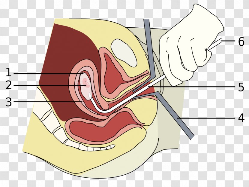 Vacuum Aspiration Miscarriage Abortion Surgery Dilation And Curettage - Cartoon - Pregnancy Transparent PNG
