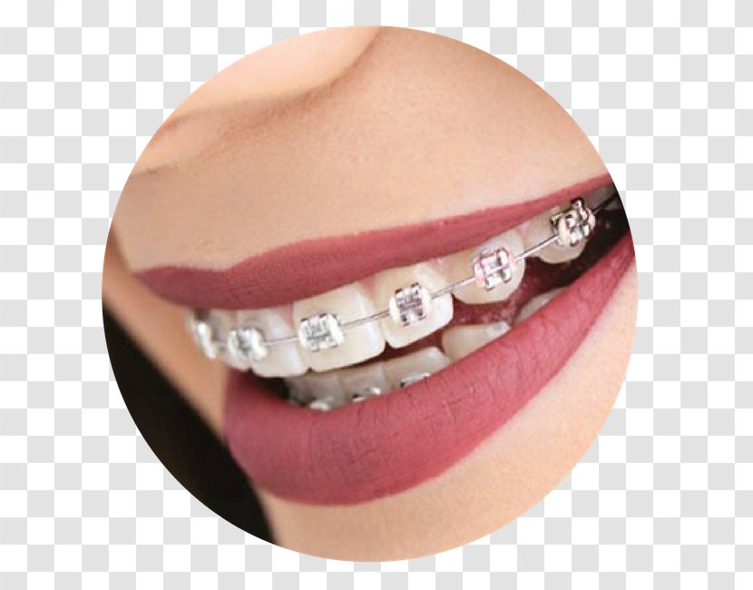 Dental Braces Tooth Dentistry Video - Sorriso Dentes Transparent PNG