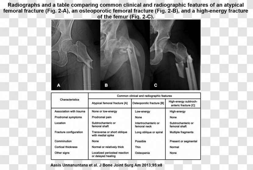Femoral Fracture Osteoporosis Femur Bone Lisfranc Injury - Keyword Tool Transparent PNG