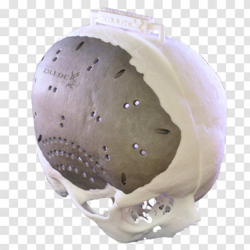 Skull Cranioplasty Brain Implant Titanium - Fibrous Dysplasia Of Bone Transparent PNG