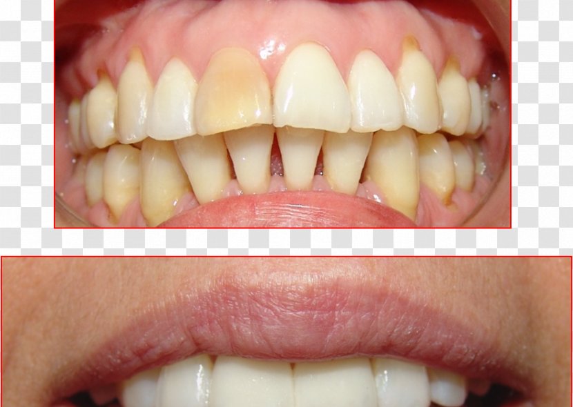 Tooth Ceramic Dental Restoration Resin Dentistry - Cosmetic - Lip Transparent PNG