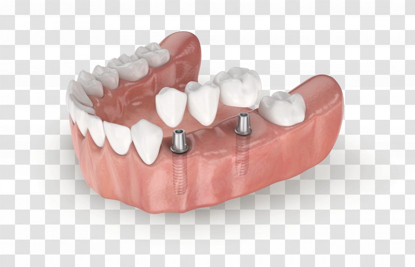Tooth Jaw Dentures Dental Implant LASAK - Prosthodontics Transparent PNG