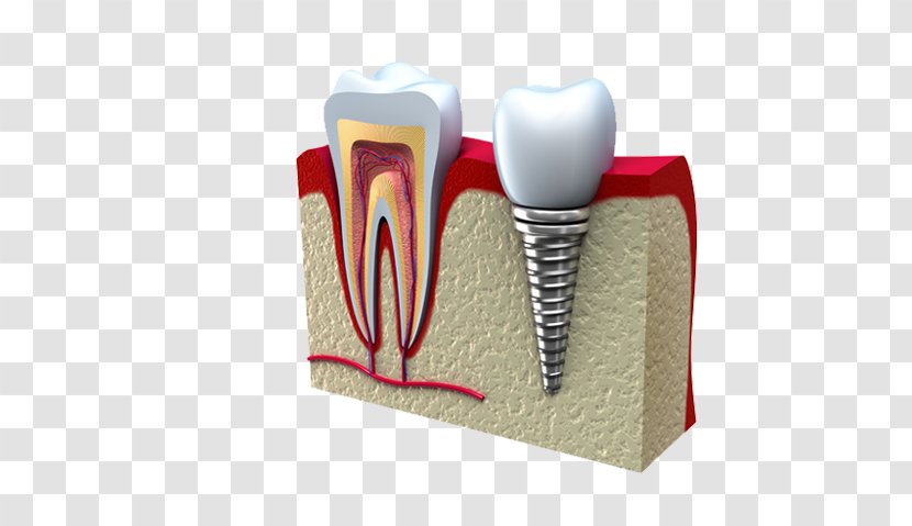 Dental Implant Dentistry Molar - Silhouette - Crown Transparent PNG