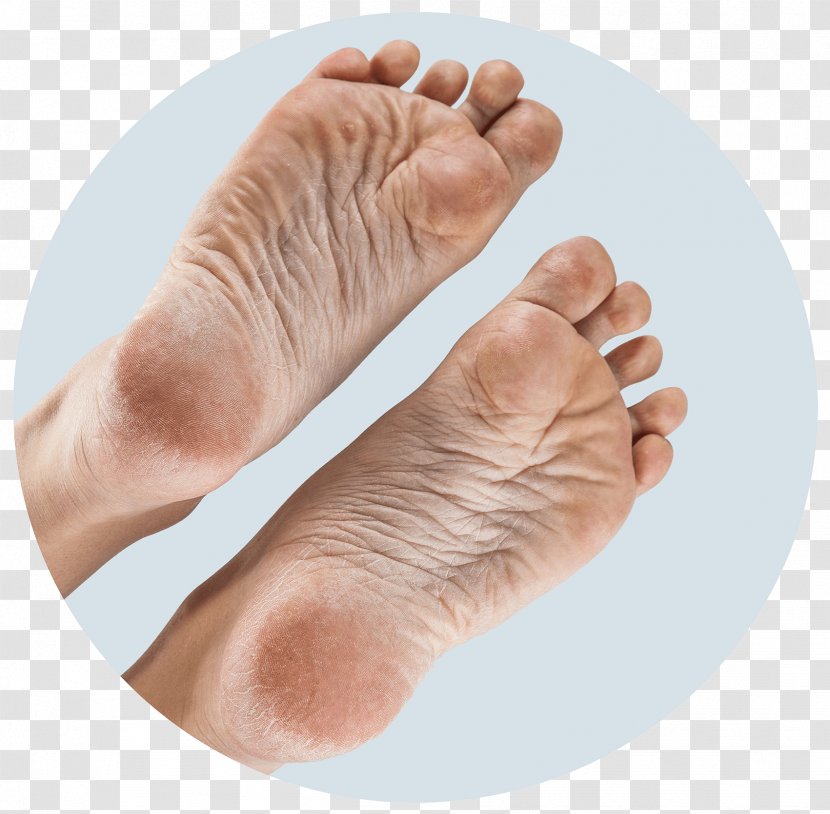 Foot Sole Callus Joint Hand - Tree Transparent PNG