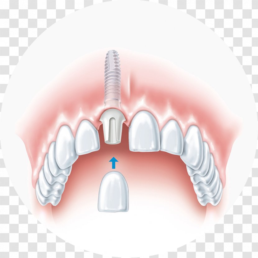 Dental Implant Dentistry Bridge - Tree Transparent PNG
