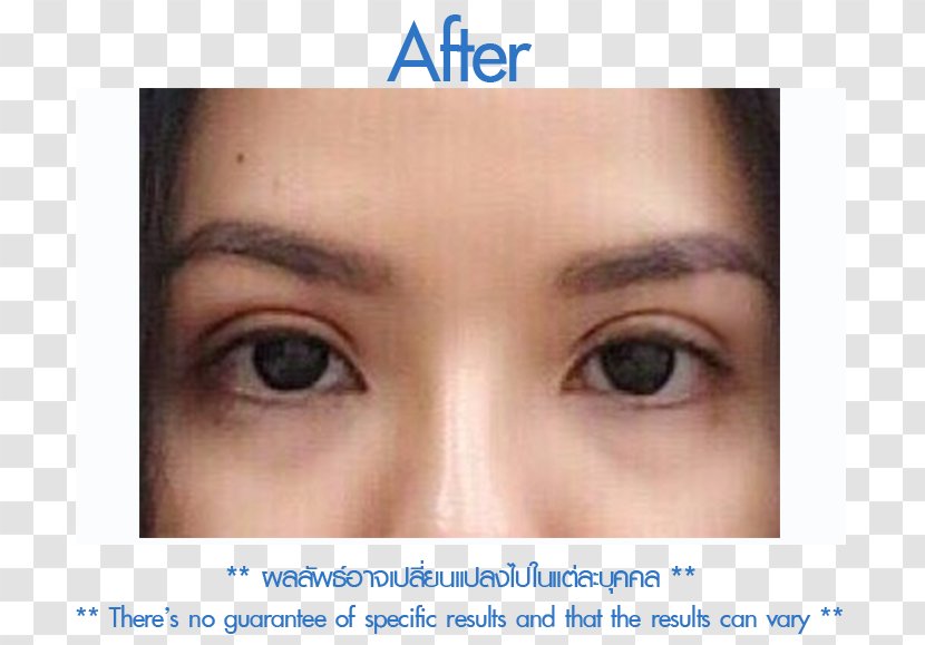 Follicular Unit Extraction Skin Forehead Eyebrow Cheek - Mupai Transparent PNG