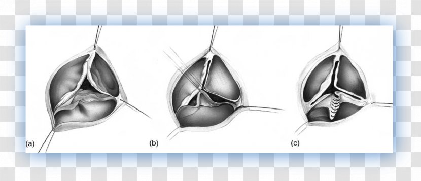 Aortic Valve Left Coronary Artery Circulation Aorta - Radial - Percutaneous Replacement Transparent PNG