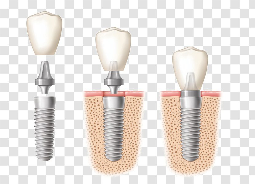 Dental Implant Dentistry Tooth - Therapy - Dentist Transparent PNG