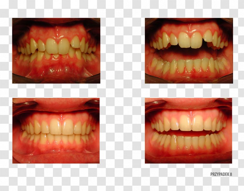 Tooth Camera Therapy Orthodontist Patient - Palatine Bone Transparent PNG