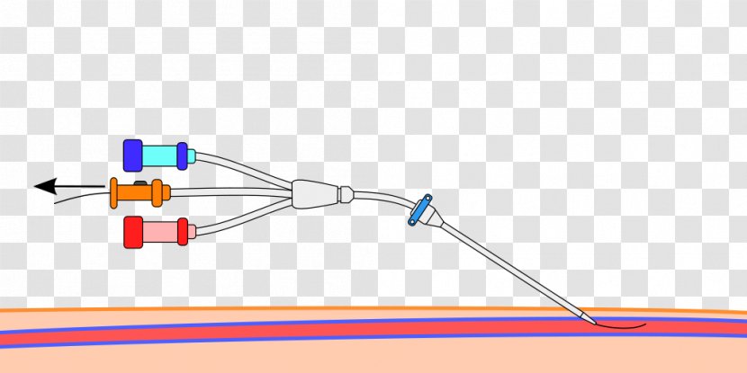 Seldinger Technique Central Venous Catheter Peripheral Trocar - Technology Transparent PNG