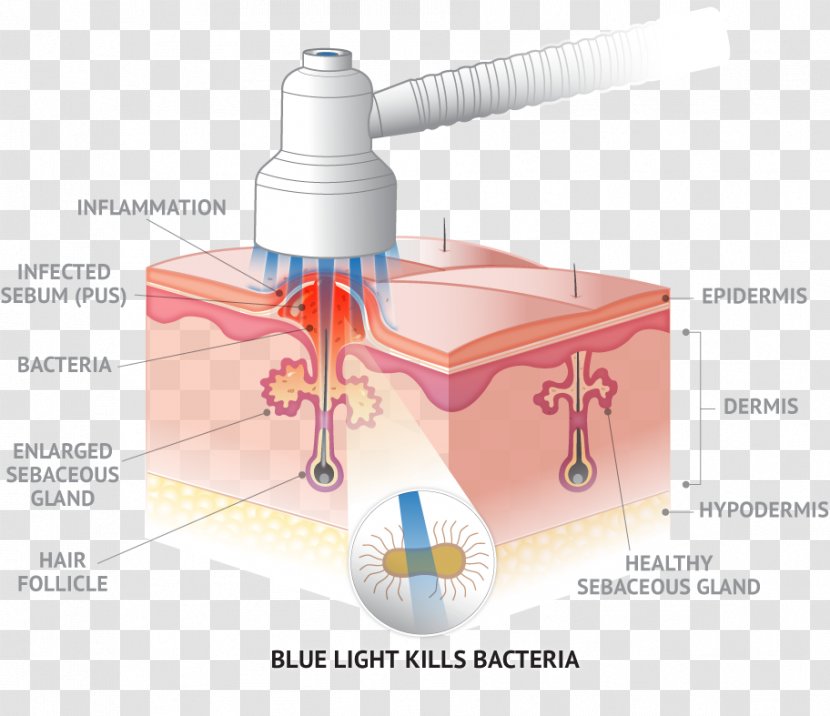 Quasar MD BLUE Light Therapy DTLA Derm Skin Transparent PNG
