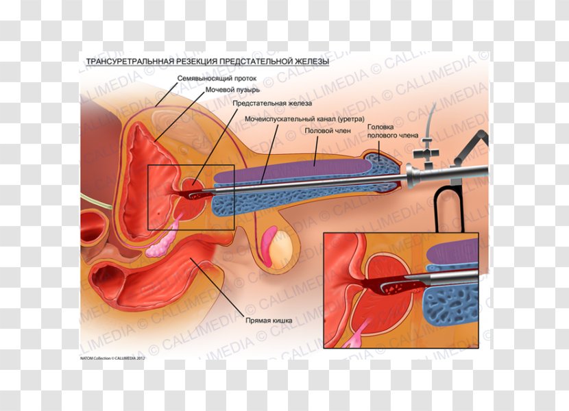 Transurethral Resection Of The Prostate Cancer Benign Prostatic Hyperplasia Surgery - Watercolor Transparent PNG