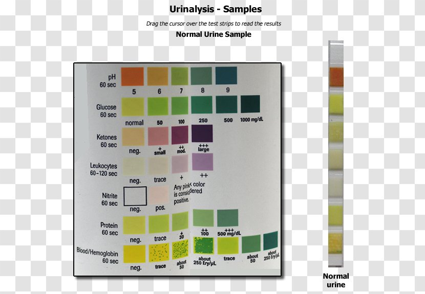 Human Anatomy & Physiology Clinical Urine Tests Test Strip Ketone Bodies - Glucose Transparent PNG