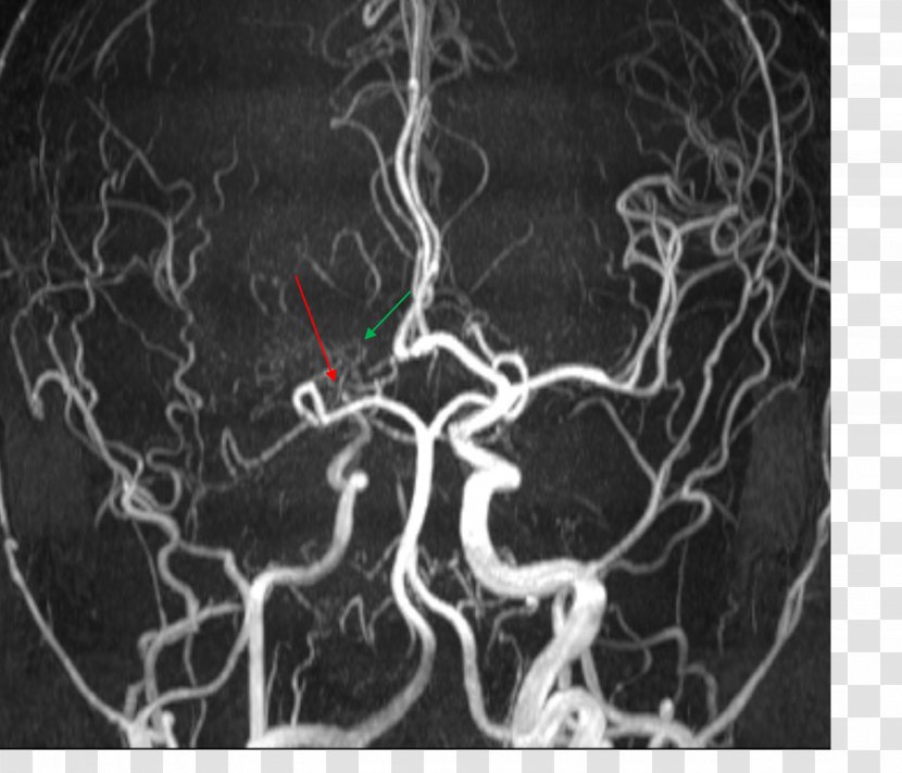 Medical Imaging Magnetic Resonance Angiography Moyamoya Disease - Flower - Posterior Cerebral Artery Transparent PNG