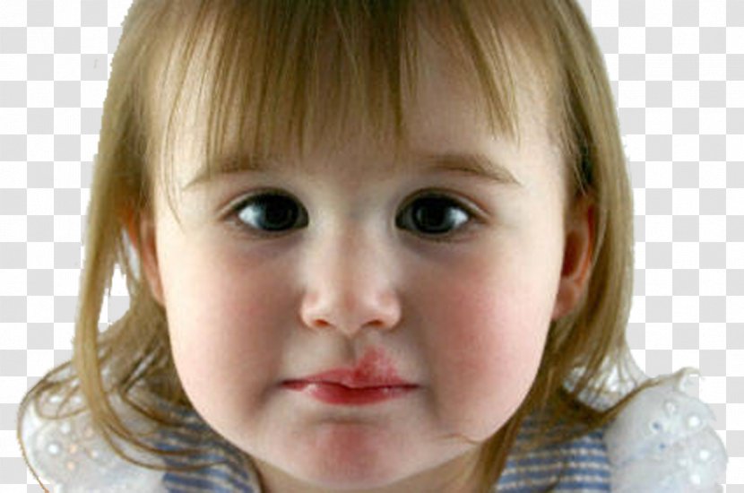 Herpes Labialis Canker Sore Skin Ulcer Simplex Lip - Tree - Childhood Chickenpox Transparent PNG
