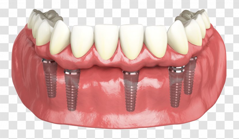Hybridge Dental Implants Dentistry - Crown - Cosmetic Transparent PNG