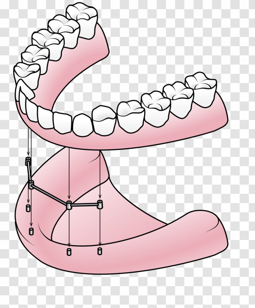 Dental Implant Dentures Dentistry All-on-4 - Mandible - Footwear Transparent PNG