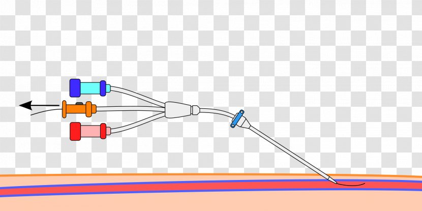 Central Venous Catheter Seldinger Technique Peripheral Cardiac Catheterization - Surgery Transparent PNG