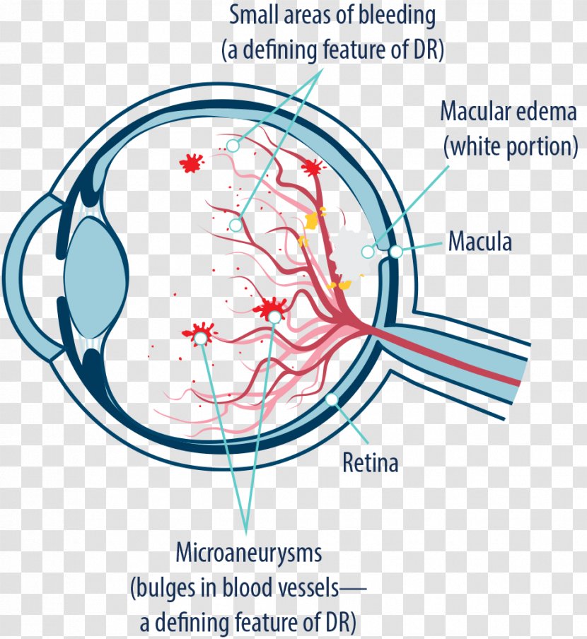 Macular Edema Diabetic Retinopathy Macula Of Retina Degeneration Diabetes Mellitus - Heart - Eye Transparent PNG