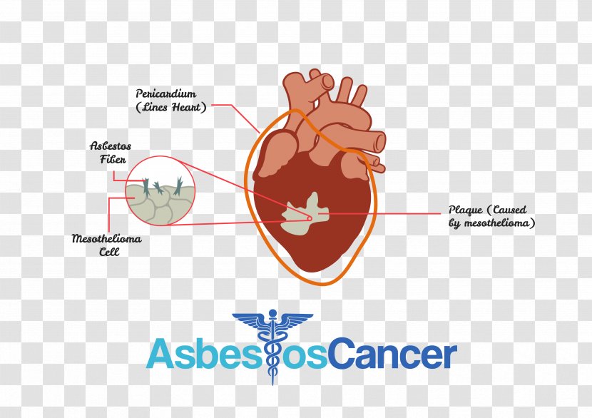 Mesothelioma Cancer Asbestos-related Diseases Chemotherapy - Silhouette - Diagnosis And Treatment Transparent PNG
