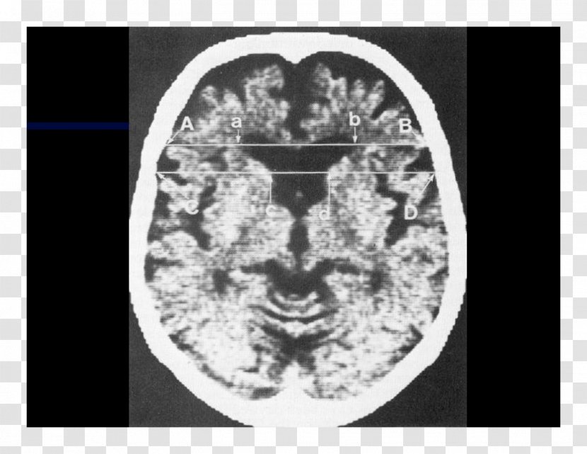 Computed Tomography Brain White Font - Silhouette Transparent PNG