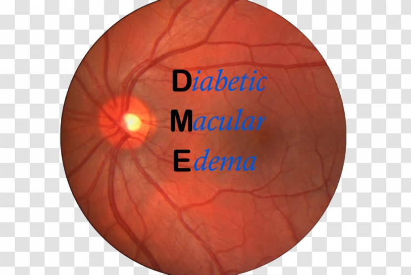 Macular Edema Macula Of Retina Diabetic Retinopathy - Orange Transparent PNG